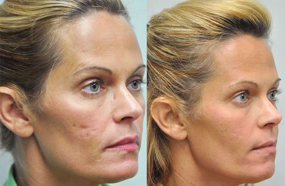 Acne Scarring Before & After Savannah Facial Plastic Surgery